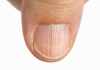Vertical Ridges On Nails- Cause and Easy Treatment in 2021 vertical ridges on nails