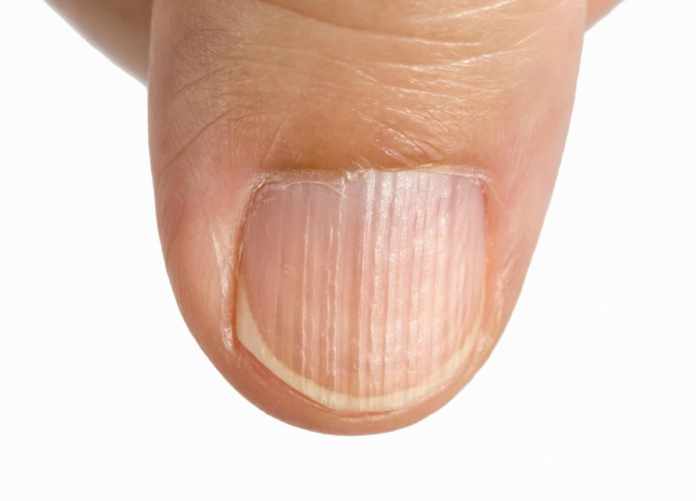 vertical ridges on nails