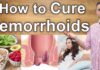 How to Cure Hemorrhoids: Effective Strategies how to cure hemorrhoids