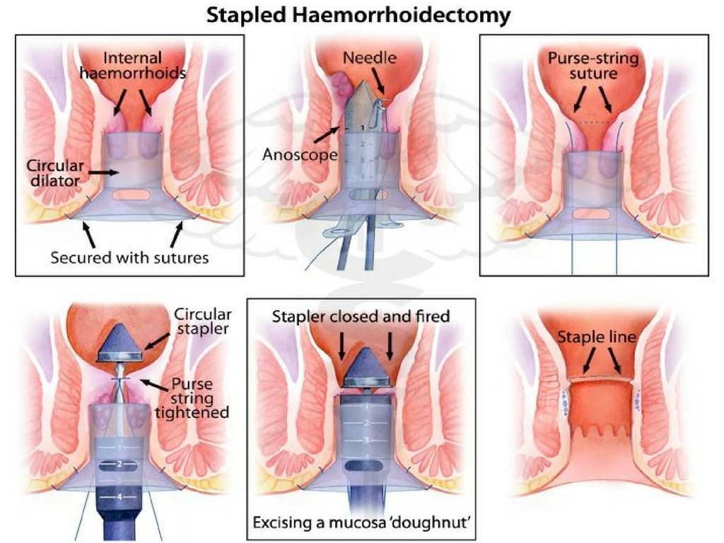 hemorrhoidectomy