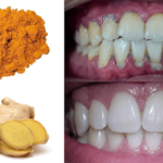 how to cure gum disease at home
